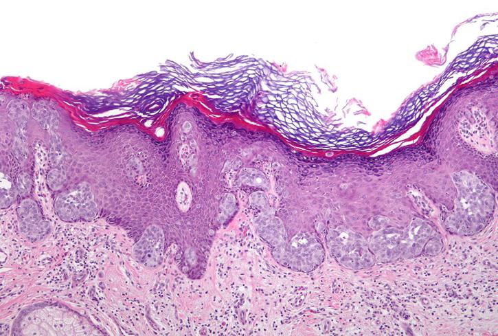 radiación de rayos verdaderos para el cáncer de próstata